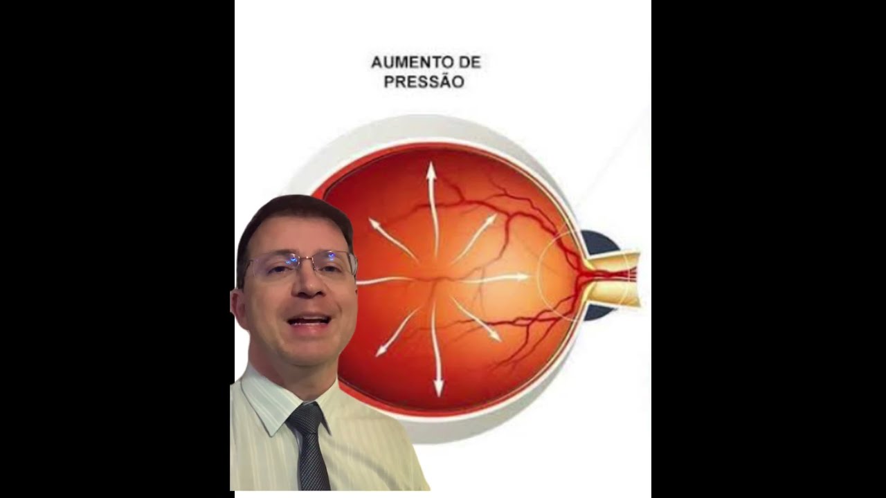 O que e Glaucoma No Olho Sintomas [ 2023 Resolvido ]