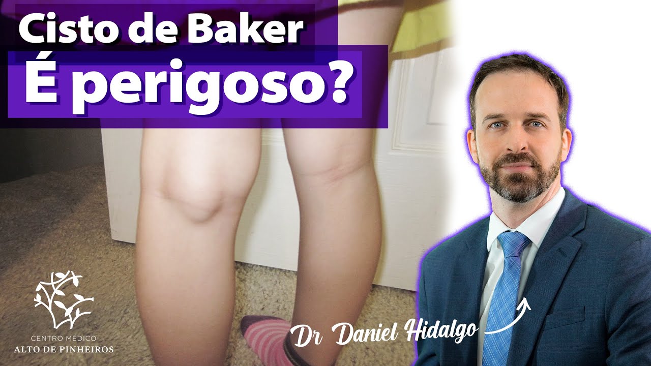 O que é Cisto De Baker [ 2023 Resolvido ]