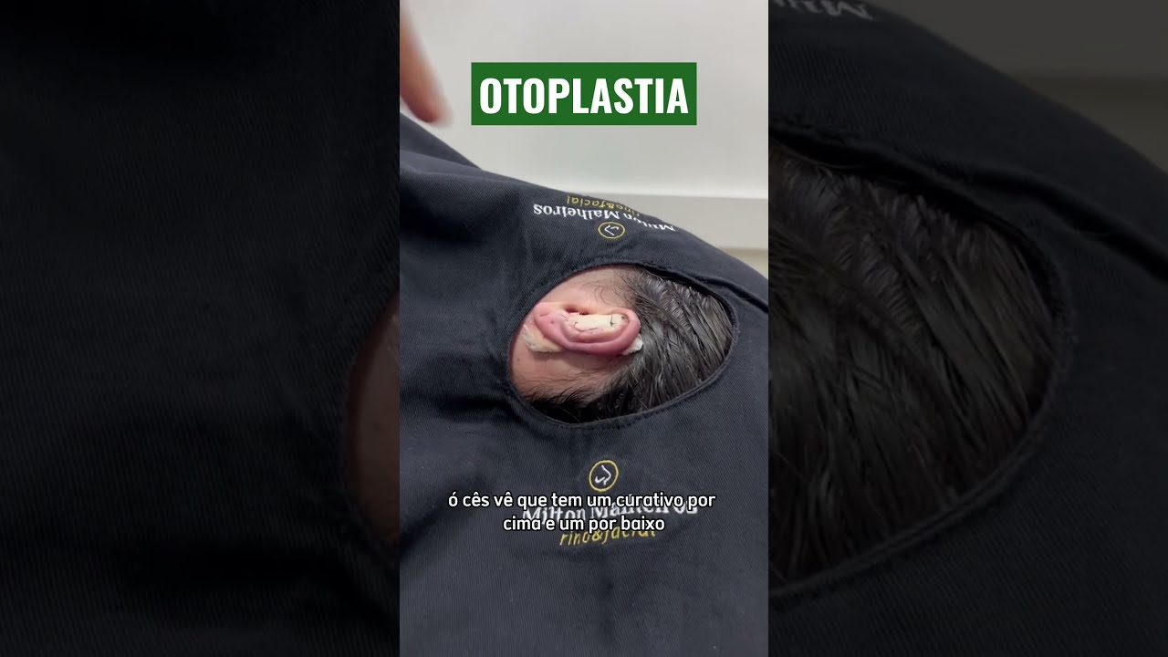 O que é Otoplastia [ 2023 Resolvido ]