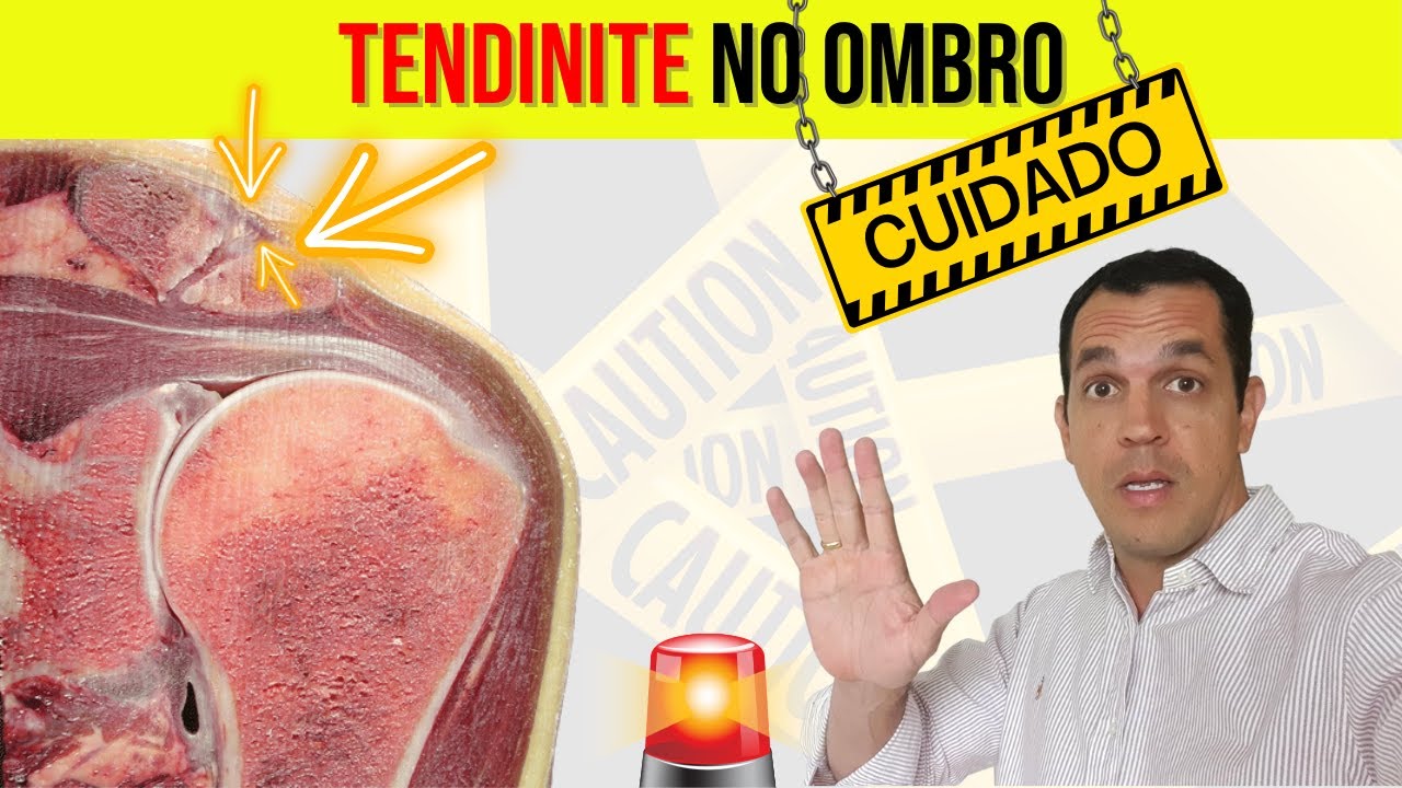 O que Causa Bursite No Ombro [ 2023 Resolvido ]