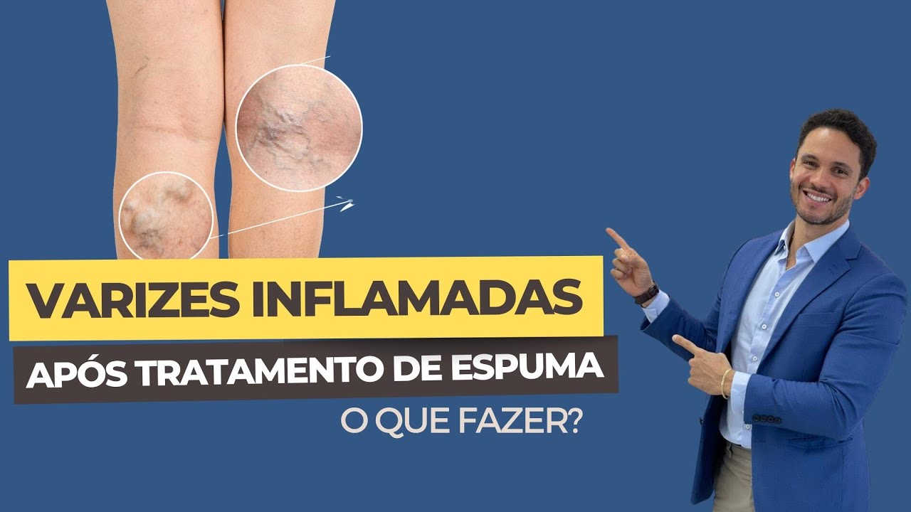 O que é Escleroterapia [ 2023 Resolvido ]