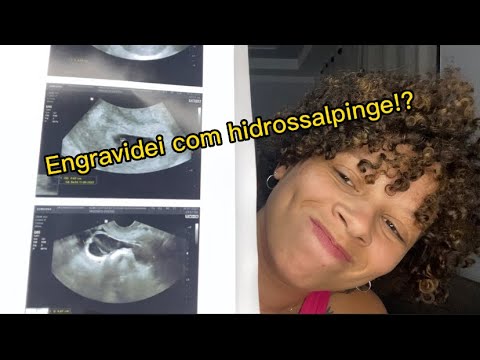 O que é Hidrossalpinge [ 2023 Resolvido ]