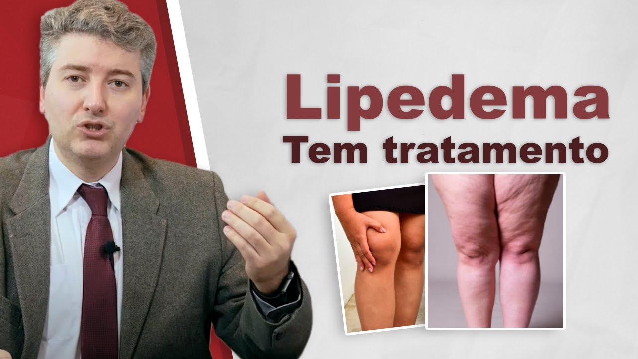 O que é Linfedema Nas Pernas [ 2023 Resolvido ]