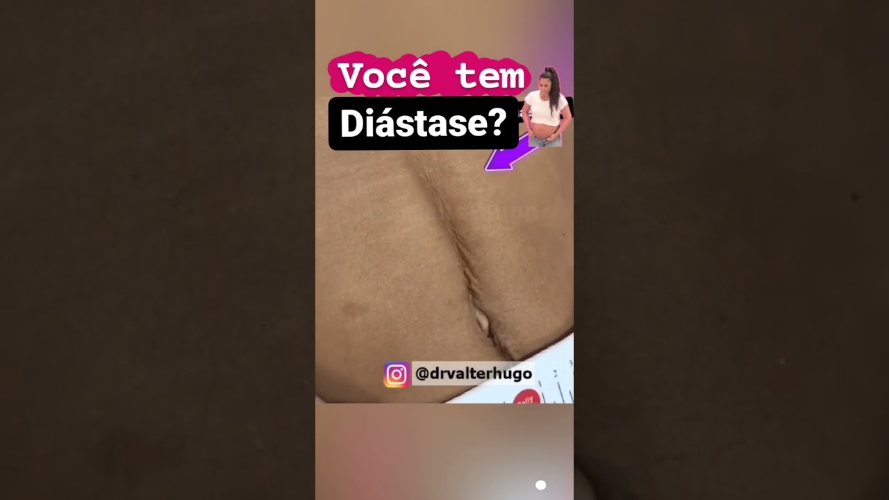 O que é Diástase Abdominal Fotos [ 2023 Resolvido ]