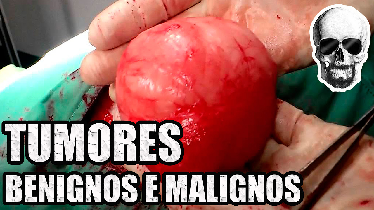 O que é Sarcoma [ 2023 Resolvido ]