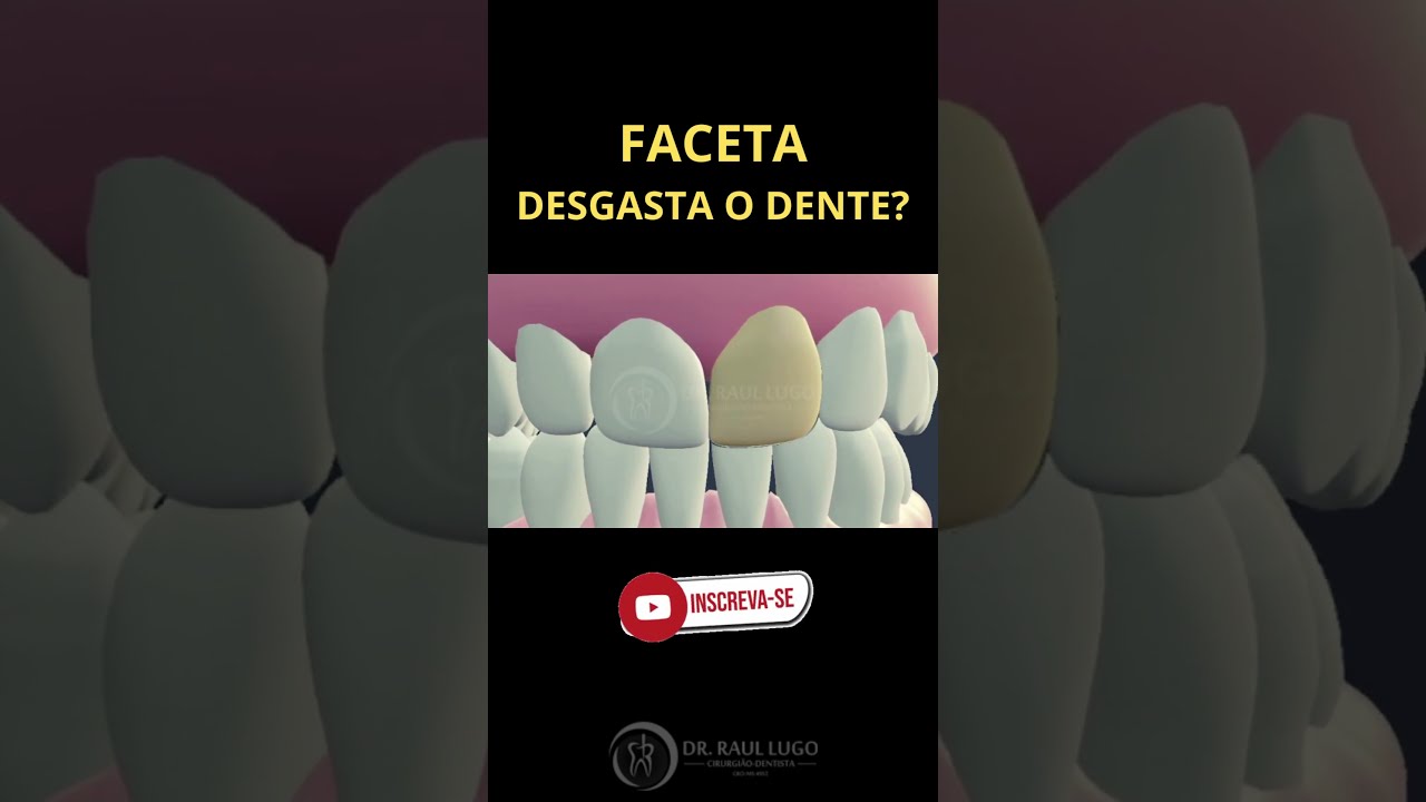 O que é Faceta Dentária [ 2023 Resolvido ]